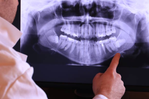 Best Emergency Root Canal Treatment in Wolcottville, IN